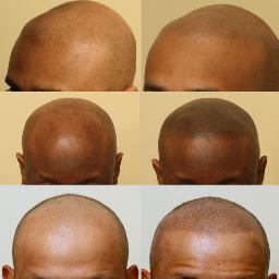 Scalp Micro pigmentation is the latest non-surgical solution to hair loss problems, embarrassing scars and providing skin rejuvenation with instant results.