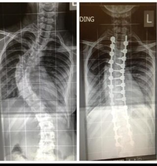 Spinal fusion: 1/11/12. 90 degrees on my top curve, and 40 degrees on my bottom. 11 hours, 2 rods and 28 screws later, i was straight again. #Scoliosis