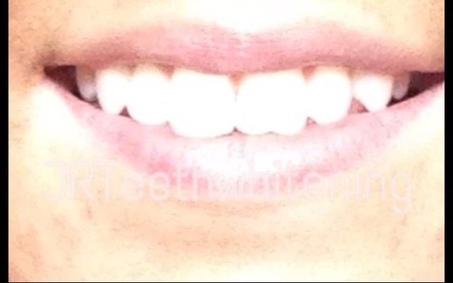 laser teeth whitening.