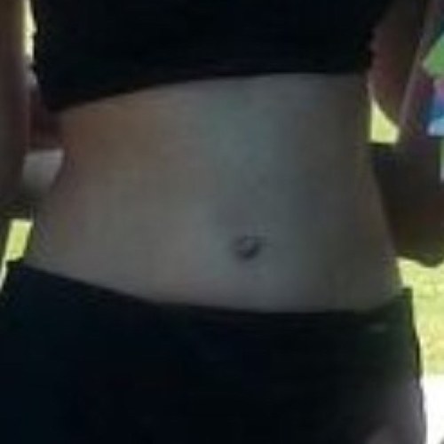 14 year old with scoliosis.