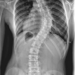 Hello. I live everyday with scoliosis. What's your super power? ✨ Bent not broken ✨