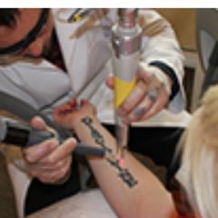 Laser tattoo removal.
