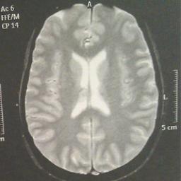 Cordon bleu quadragénique pas écrivain mais presque. #spoonie #trigeminalneuralgia #neuropathicpain #teamparents