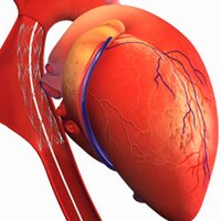 Coronary Stenosis (@coronarystent) 's Twitter Profile