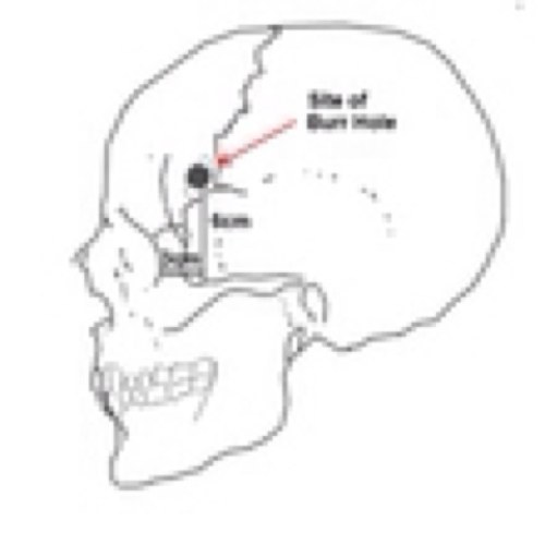 In a prolonged acute phase of CFS/ME. Please feel free to look that up :). My condition is neither trivial, nor illusory. Problem? Your problem.