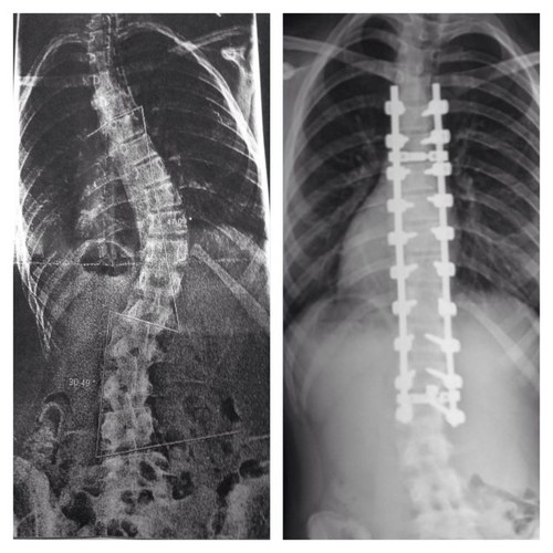 ScoliPrincess's profile picture. Diagnosed with scoliosis 2011,  braced for 3 years, fused June 17, 2013. #scoliosis #FusedAndFaboulous To God Be The Glory