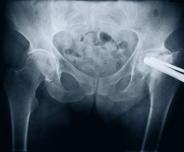 strykerhipfaq's profile picture. Were you injured by a Stryker hip implant device? This account was designed to help connect you with the latest news stories on the Stryker hip recall.