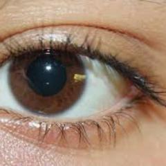 Cataract and + and  -, BOTH Sph.l and Cyl. Spects Removed with Herbal Eye Drop Only. No laser,no operation.Also glaucoma  and Retinal Disorders Since 1964.