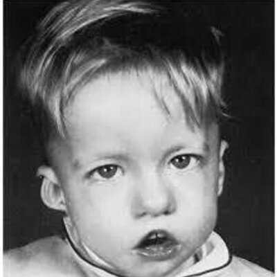 Di George Syndrome Digeorgesndrome Twitter Di George Syndrome Digeorgesndrome Twitter