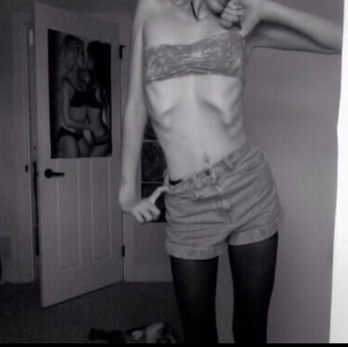 ~15~anorexic~bulimic~depressed~bipolar~ H:55.SW:230.CW:170.GW1:150.GW2:130