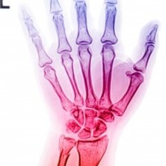 CRPSSupport's profile picture. Place of support, encouragement and understanding for those with CRPS/RSD