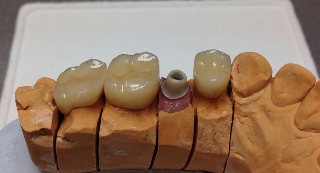 SIA Dentālā Studija augstākās kavalitātes Zobu tehnika un zobārstniecība, Augstākās kvalitātes materiāli Zirkozahn, Ceka-Preciline, Willi Geller Creation
