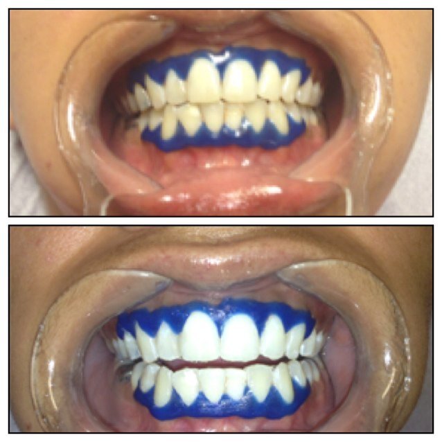 Pain Free Laser Teeth Whitening all over Northern Ireland. In Salon or home visits!