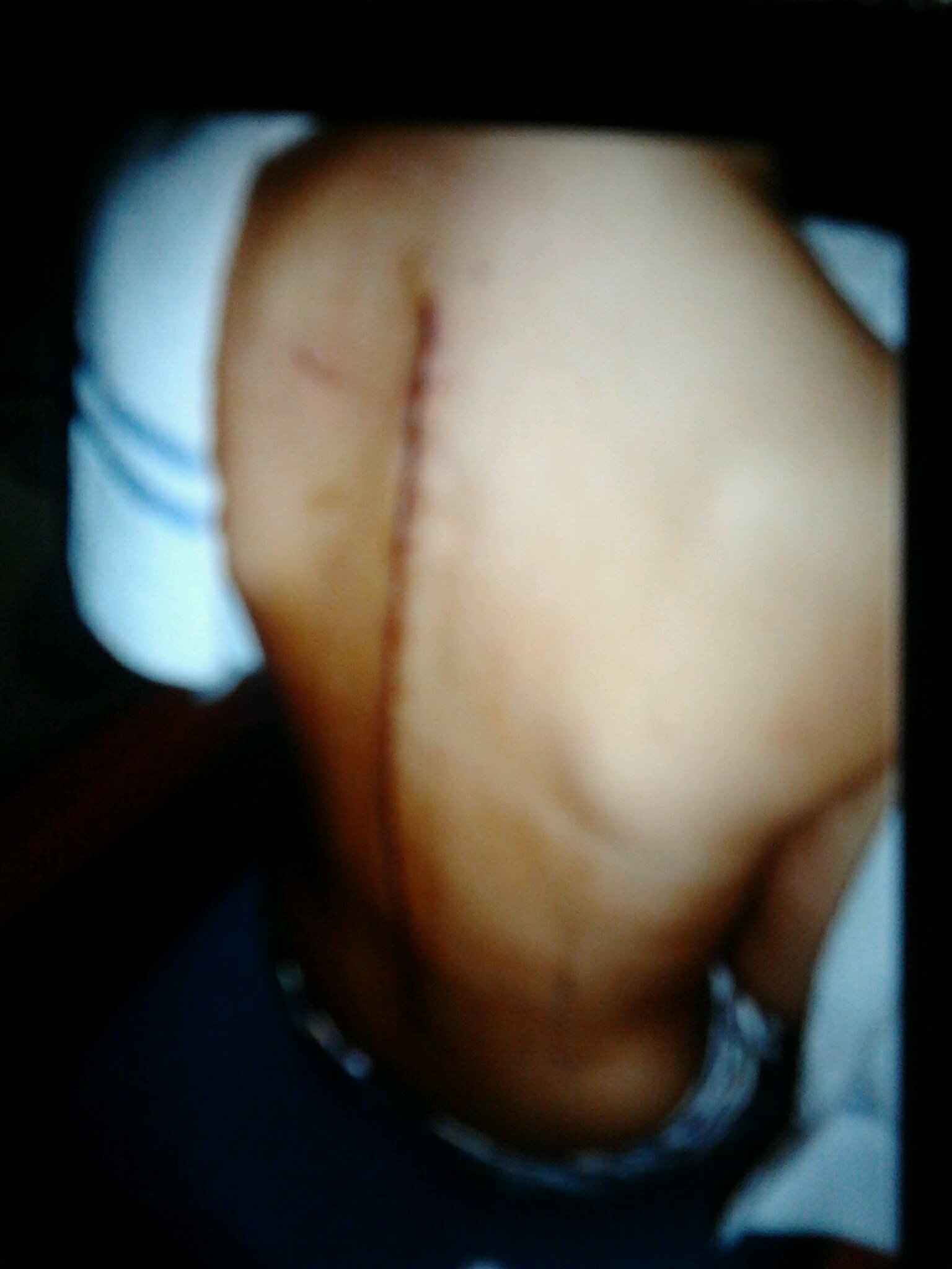 I'm 19, got diagnosed with scoliosis at 13. Got surgery 26/09/13 aged 17. If you want to know anything just ask :)