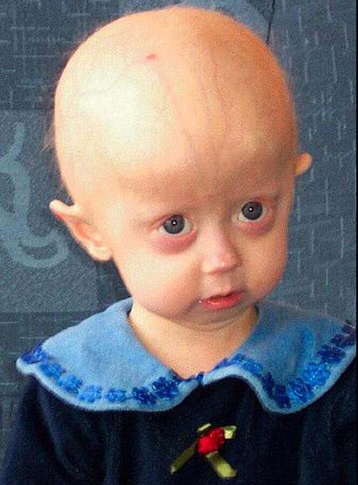 Projet de SVT sur la Progeria, maladie génétique rare et tragique ! suivez nous pour montrer que vous soutenez la maladie, merci d'avance :)