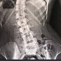 Scoliosis Probs (@scolio_probs) 's Twitter Profile