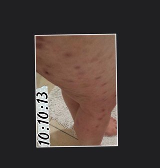 I suffer from dermatillomania and have just set up a blog to go with this twitter account, in my attempt to control this in my life and support others