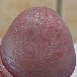 Young male suffering from a rare chronic viral std (since 2000) here to inform and educate health professionals and try to identify this pathogen.