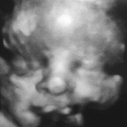 Searching for other Irish parents who have experienced stillbirth due to umbilical cord accident. Let's come together to campaign for prevention of Cord Death.