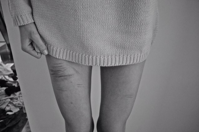 anorexia, depression, insomnia, anxiety, self harm, cw: 122 gw1: 115 gw2: 105 gw3:95 ugw:85