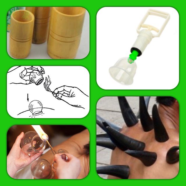 SunnaHijama4U's profile picture. Hijama Cupping Therapists working with you to revive the Sunnah. For ladies we offer weightloss and non surgical facelift treatment maa shaa Allaah.