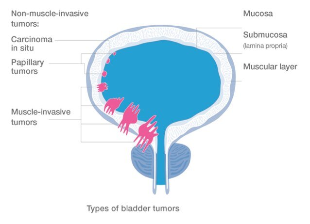 Bladder Cancer Profile