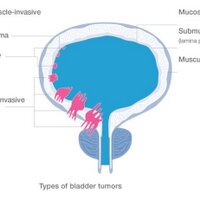 Bladder Cancer (@bladderca) 's Twitter Profile