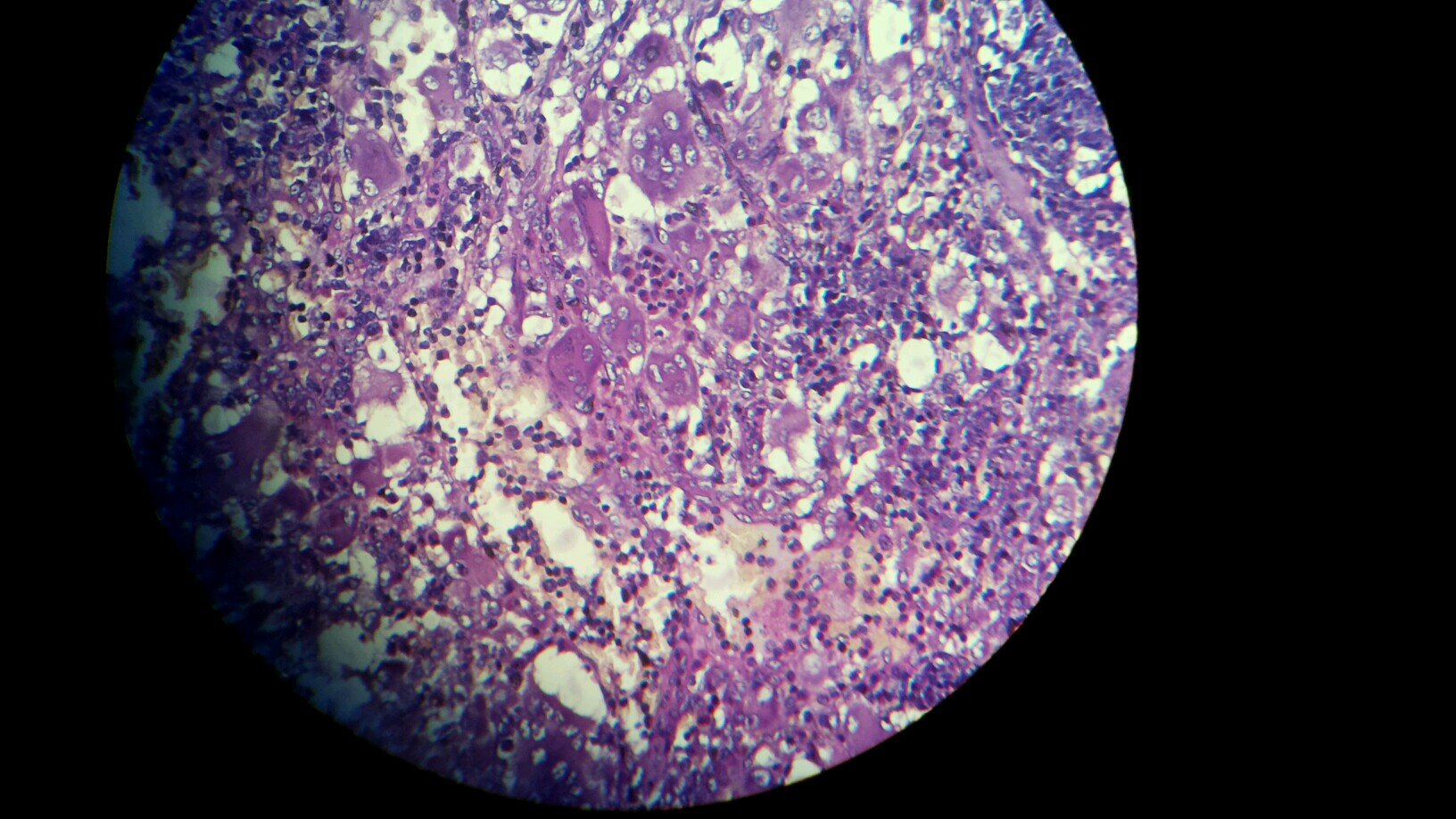 Haematology, CDDFT, United Kingdom