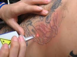 Tattoos removed in the comfort of your own home