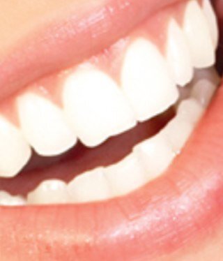 Teeth whitening non peroxide gel,up to 14 shade lighter !!!