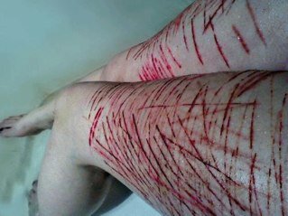 Suicide was succesful.