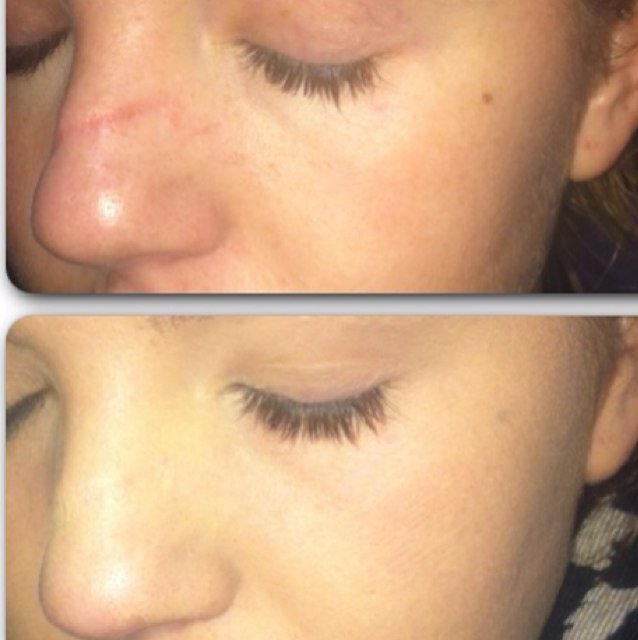 Giving you back your confidence. Scars, Burns, Tattoos, Vitiligo, Rosacea, Acne, psoriasis ETC. Fully trained Camo tech.