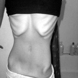 Anorexia psicológica. PI=78; PA=64; M1= 65; M2=60; M3=56; MF=?