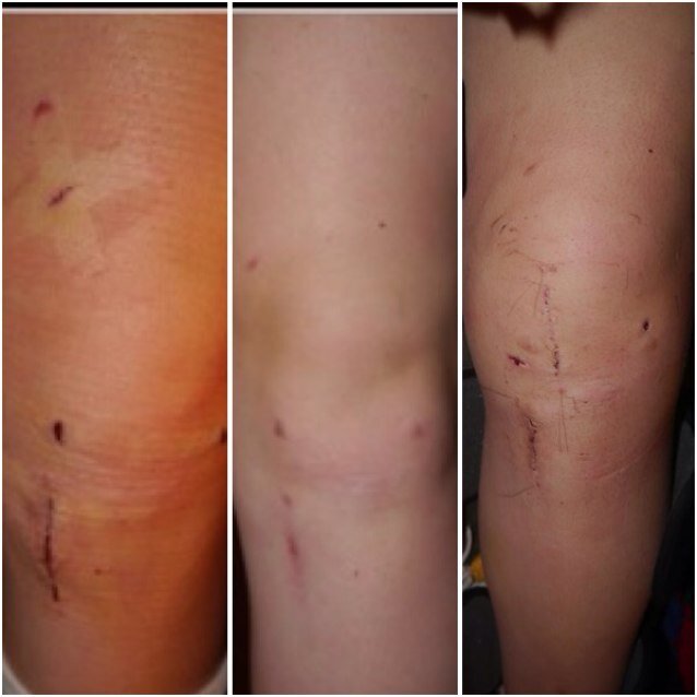 my__acl_injury's profile picture. gotta be stronger then you were before