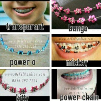 behel permanen murah meriah 380rb . lepas psang ats bwah 150rb , pin 7544D9D5 , 089651067567