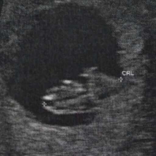 IVF_Handstand's profile picture. Hillsong Church is my home and Jesus is my hero.TTC 8yrs. 2 fresh & 2 frozen IVF = 3 BFN and 1 chemical pregnancy. 5th cycle with steroids BFP!!! EDD 23/7/14!!!