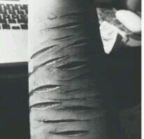 TRIGGER WARNING!!! -15- -bulimia- -eating disorders- -selfharmer-hospitalized: 3