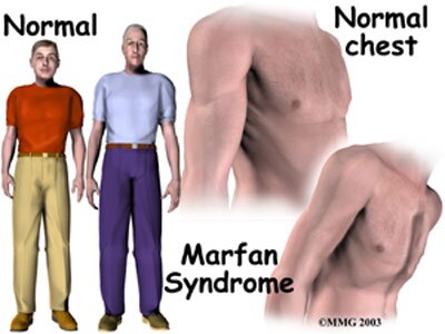 Facts about Marfan Syndrome.