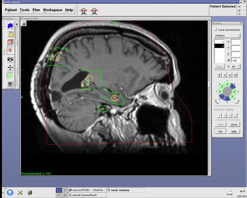 Being diagnosed with cancer is difficult…learning that it has spread to the brain can be devastating.