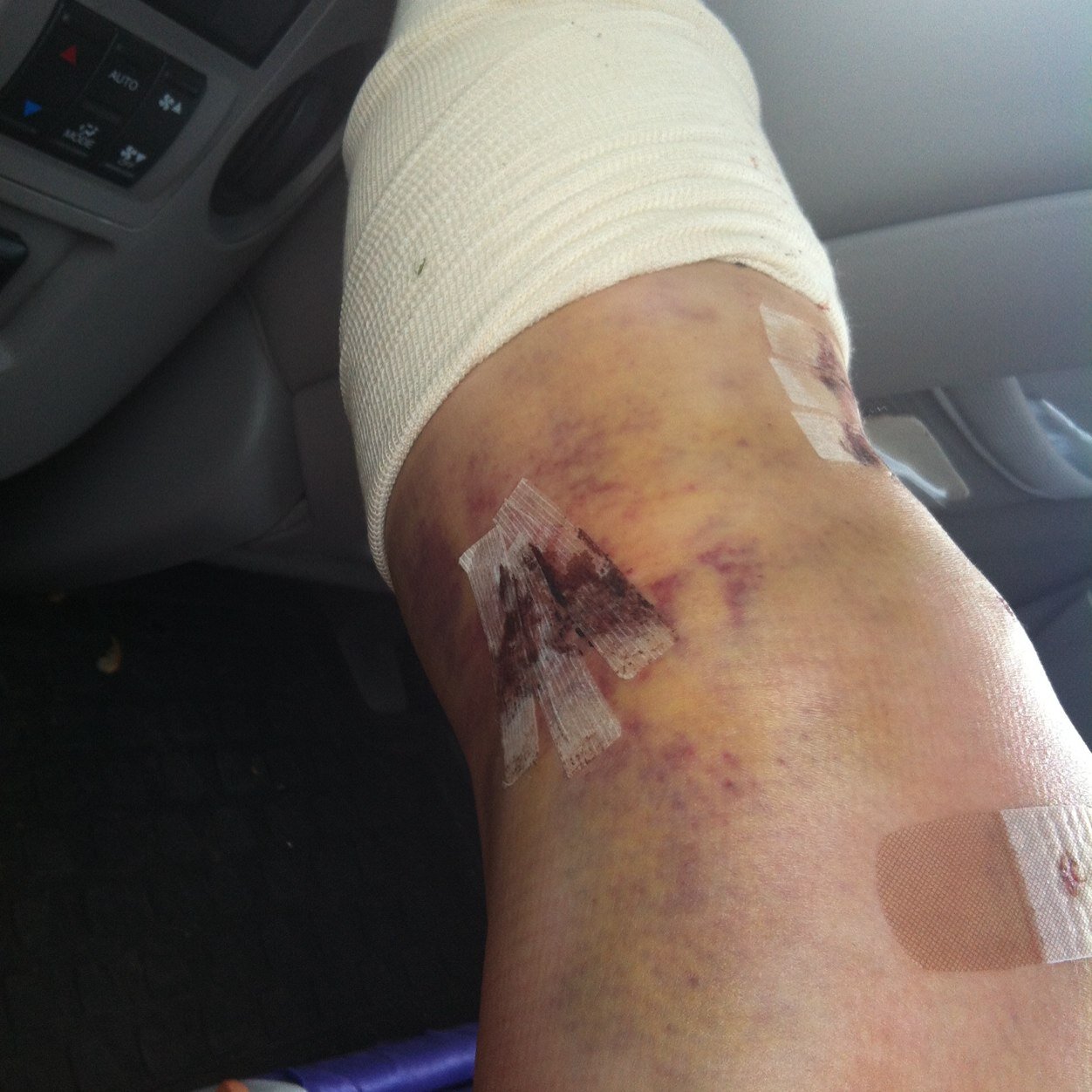 aclrecovery3's profile picture. Here to help anyone going through an injury
I play Soccer and basketball
Tore my acl last april had surgery in june 1 more month till im hopefully cleared