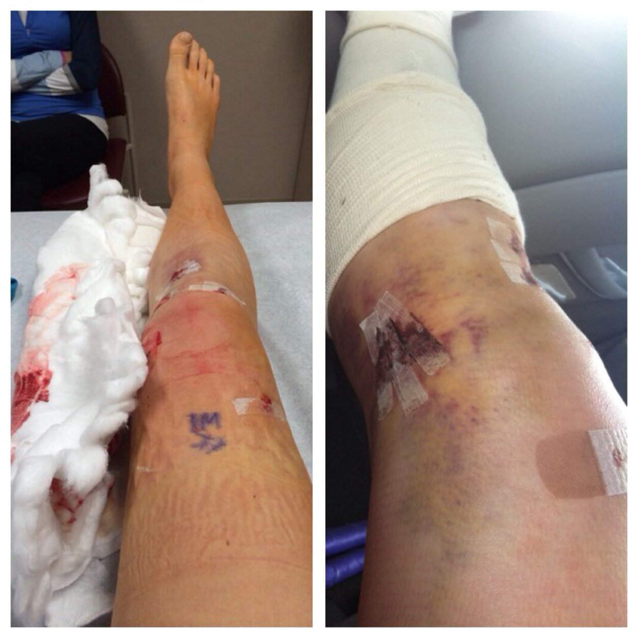 aclprobs327's profile picture. 2 freshmen girls who have torn their acl and are gonna share their experiences along their rodes to recovery 2/6/13 and 11/30/13
