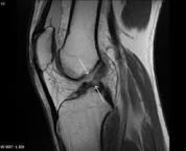 ACLBlog's profile picture. Hamstring ACL surgery 17/12/13
 Tweeting about rehab and experiences
Aiming to get back to playing rugby in 2014