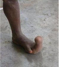 je suis un gros doigt d'pieds !