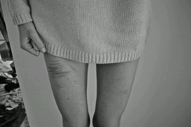 [Dutch, 18, Female] Anorexic for 7 years, selfharmer for 6 years. Relapse/recovery. | Christian † | Already Taken | #BBM ask