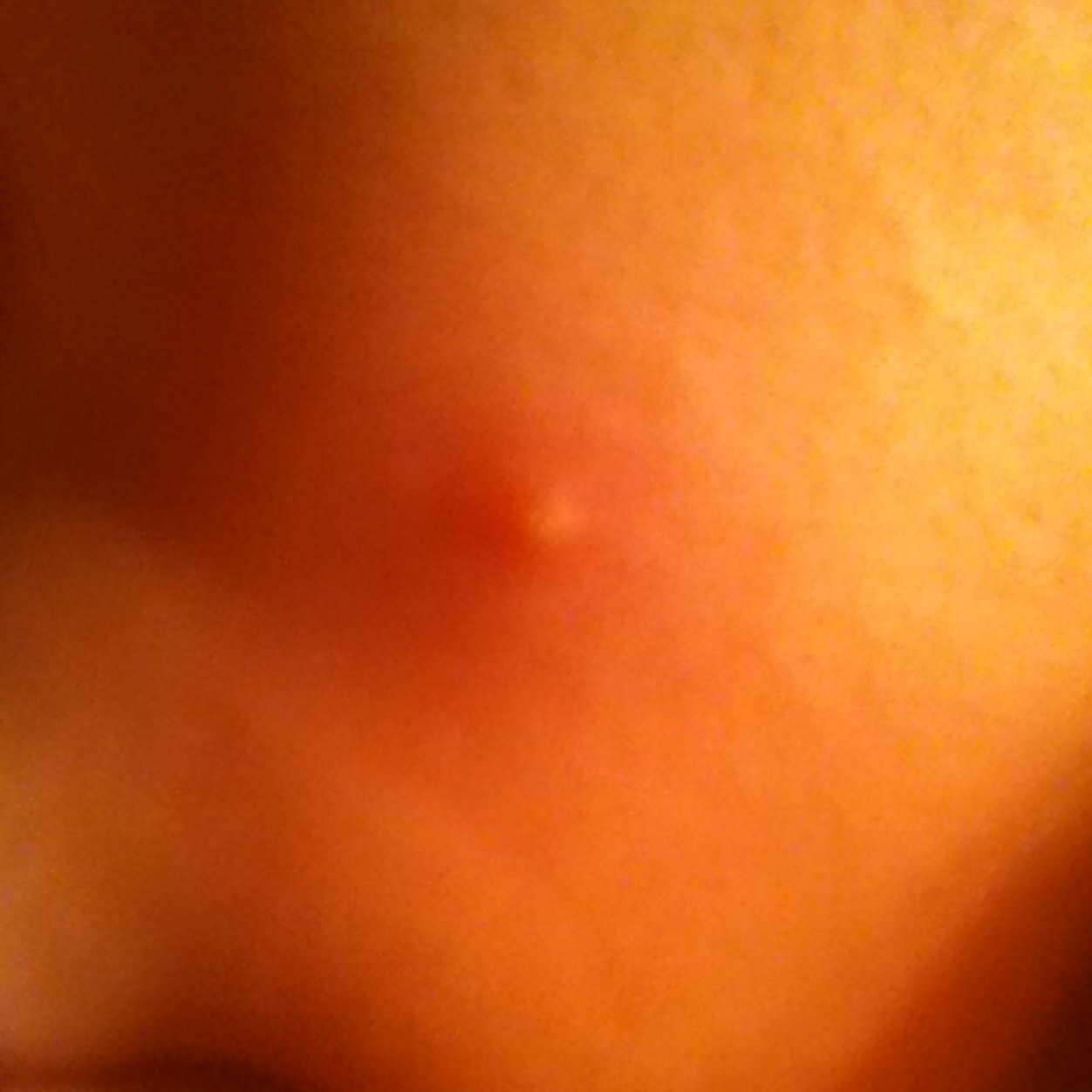MyPimples's profile picture. 