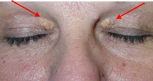 XanthelasmaMed's profile picture. Xanthelasma (or xanthelasma palpebrarum) is a sharply demarcated yellowish deposit of fat underneath the skin, usually on or around the eyelids.