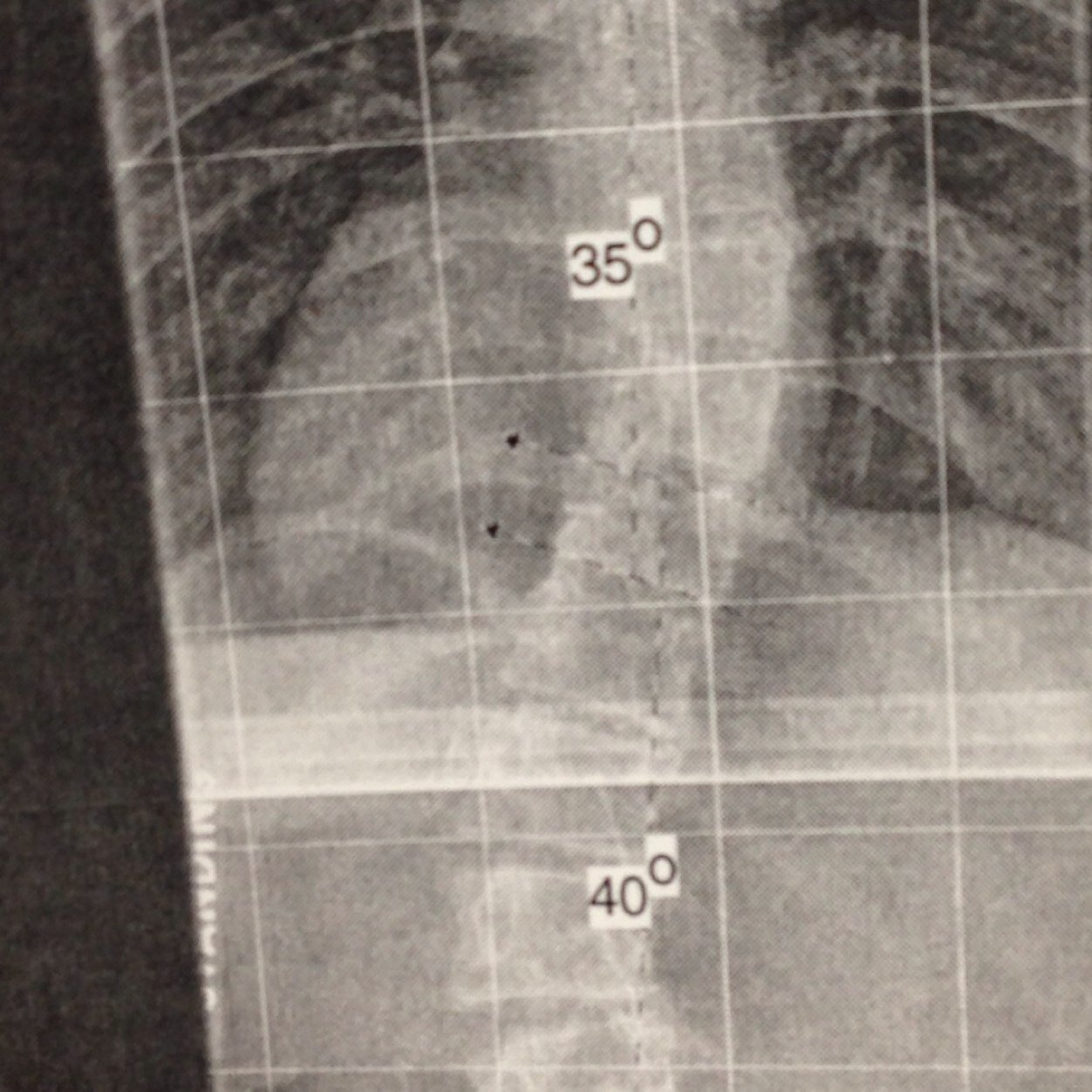 bent but not broken•diagnosed with idiopathic scoliosis•boston brace