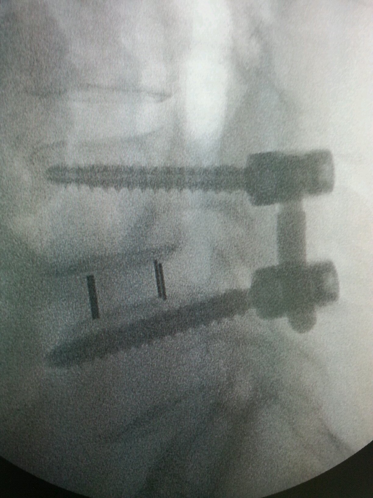 spinesurgeryPTY's profile picture. cirugía de mínima invasión de columna en Ciudad de Panamá. SPINE surgery experts.