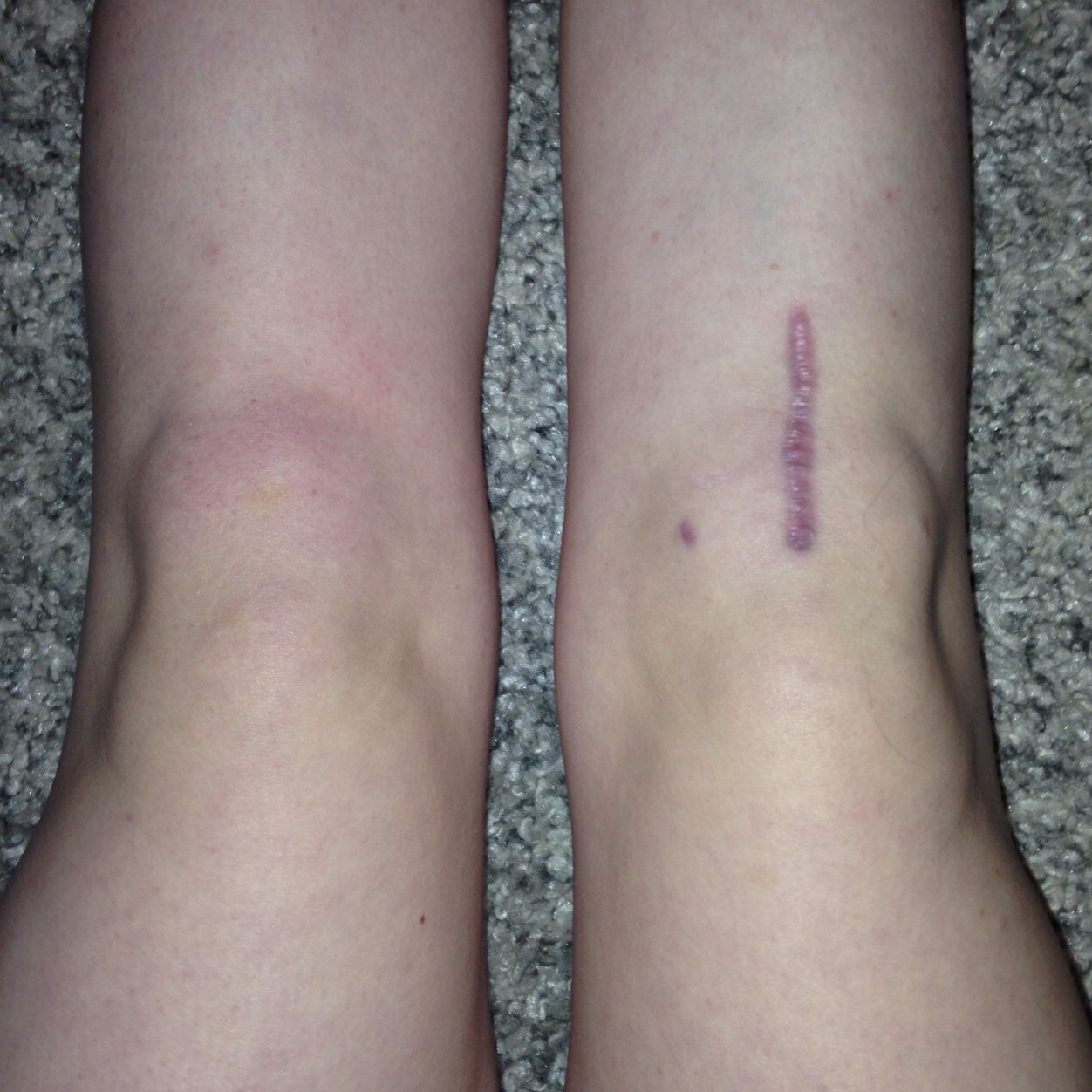 my_acl_story's profile picture. Tore my ACL and meniscus playing soccer. injury date: 10/18/12 surgery date: 7/2/13 DM me, i'll answer(: