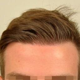 I run a showcase site with before and after photos of hair transplants